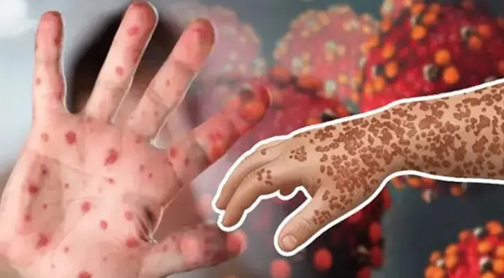 হাম ও হামের উপসর্গে আরও ৫ শিশুর মৃত্যু