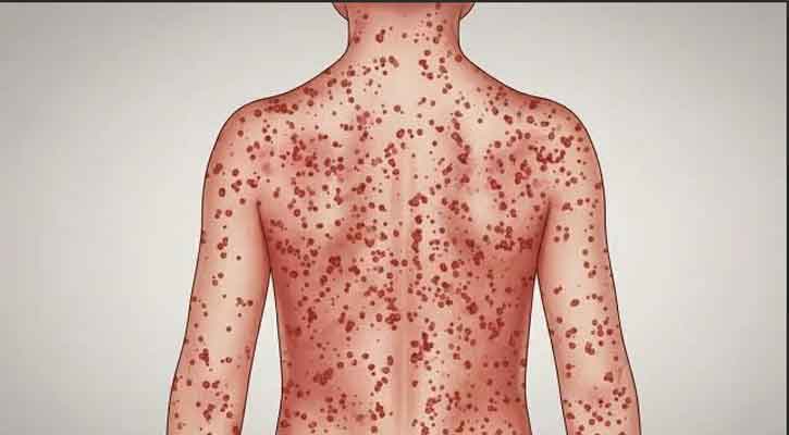 রাজশাহী বিভাগে হামের প্রাদুর্ভাব: ২৬ হটস্পট চিহ্নিত, ঝুঁকিতে প্রাপ্তবয়স্করাও