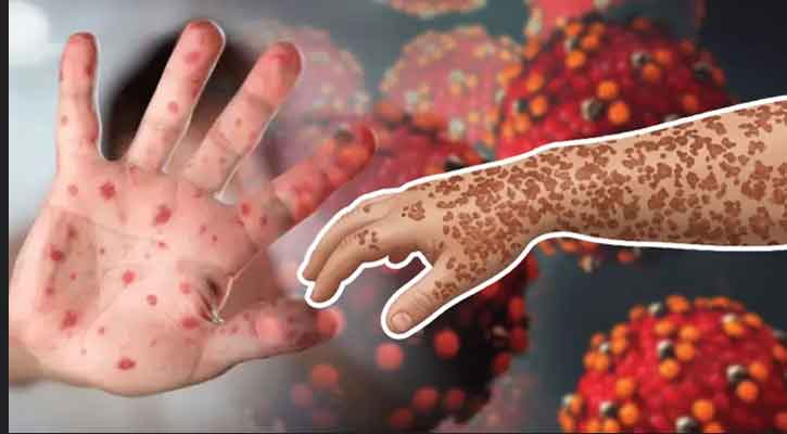 হামের উপসর্গে ১৯ দিনে ৯৪ শিশুর মৃত্যু, হাসপাতালে নতুন রোগী ৯৪৭