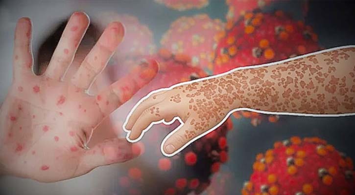 মহামারী আকার ধারণ করেছে  হাম, দ্রুত গণটিকার আহবান আইইডিসিআরের