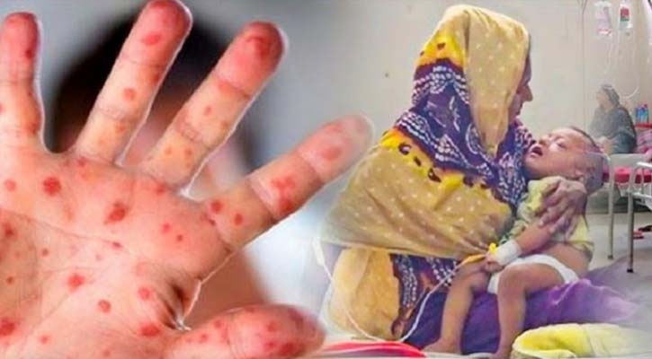 দেশের ৫৮ জেলায় ছড়িয়েছে হাম