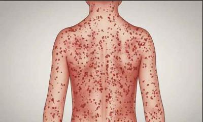 রাজশাহী বিভাগে হামের প্রাদুর্ভাব: ২৬ হটস্পট চিহ্নিত, ঝুঁকিতে প্রাপ্তবয়স্করাও