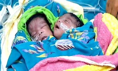 রাজশাহীতে দুইটি মাথা নিয়ে একটি শিশুর জন্ম