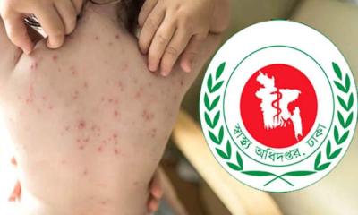 ২৪ ঘণ্টায় হাম ও হামের উপসর্গ নিয়ে ৮ জনের মৃত্যু